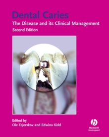 Dental caries: the disease and its clinical management, 2nd Edition